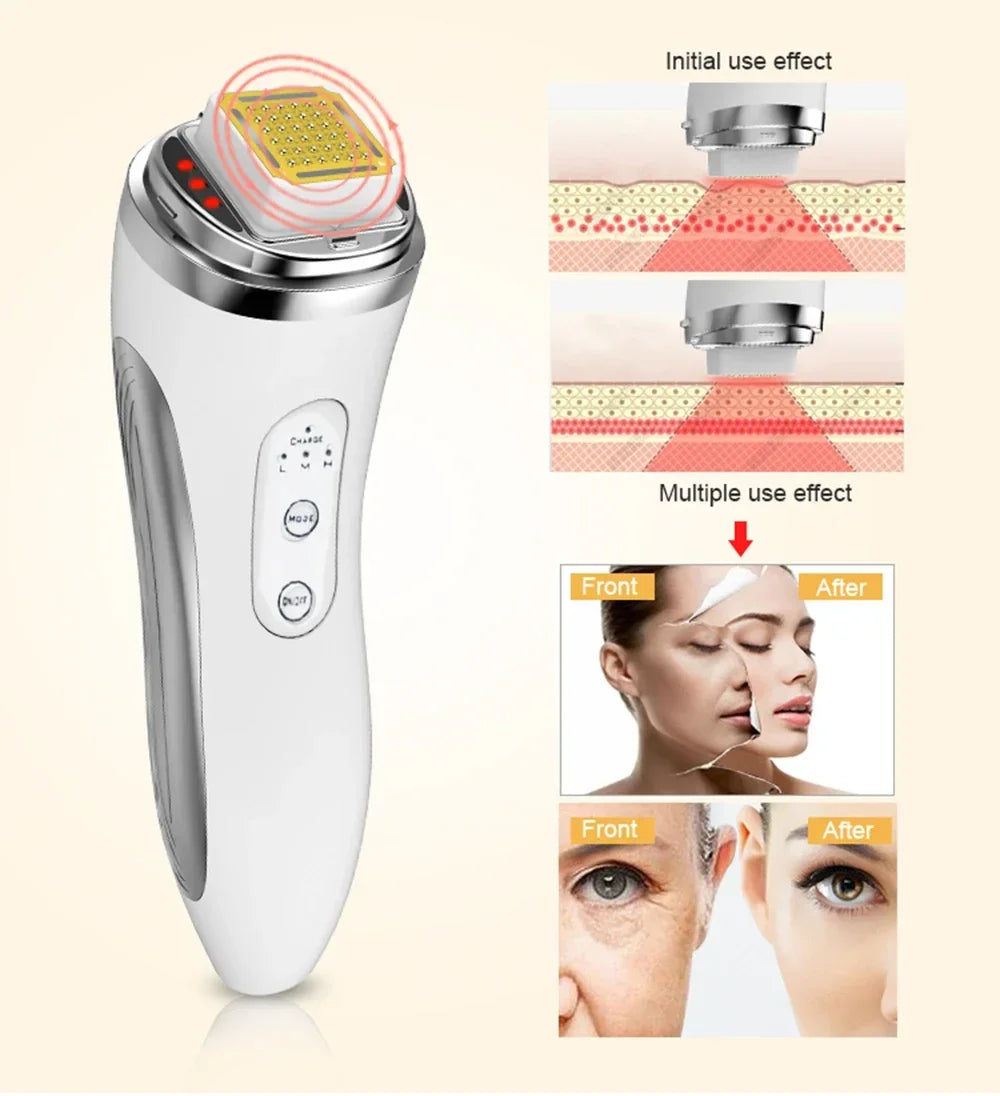 RF Facial Lifting Machine – Skin Tightening & Wrinkle Removal Tool